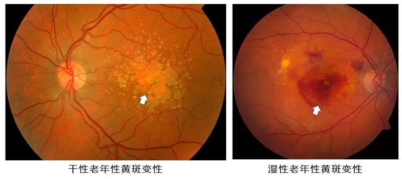 水蛭素、黃斑變性