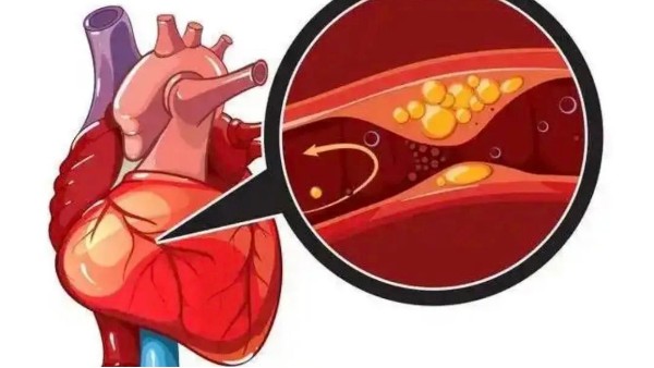 真實案例：是什么讓他堅持一年，冠狀動脈堵塞消除30%！