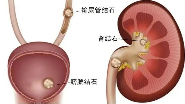 重用、活用水蛭治療尿路結石，療效較好