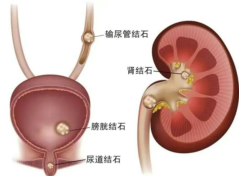 水蛭素、尿路結(jié)石、腎功能