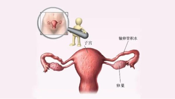 水蛭有利水道、破積聚之功，可用于治療輸卵管積水