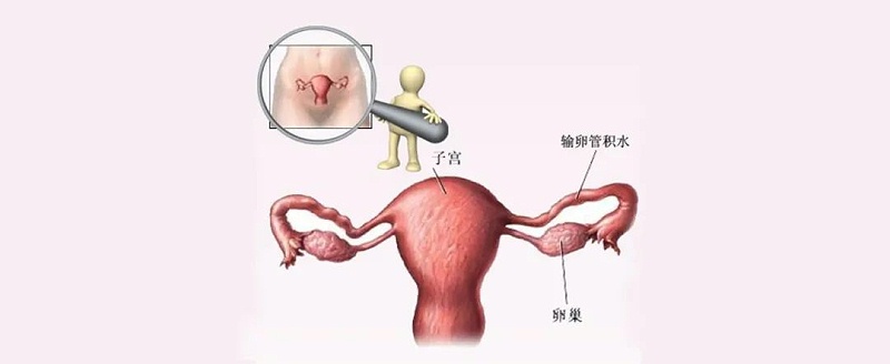 水蛭素、輸卵管積水、不孕不育