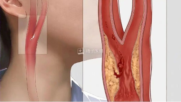 真實(shí)案例丨3個(gè)月左頸動(dòng)脈狹窄降低約27%，是怎么實(shí)現(xiàn)的？