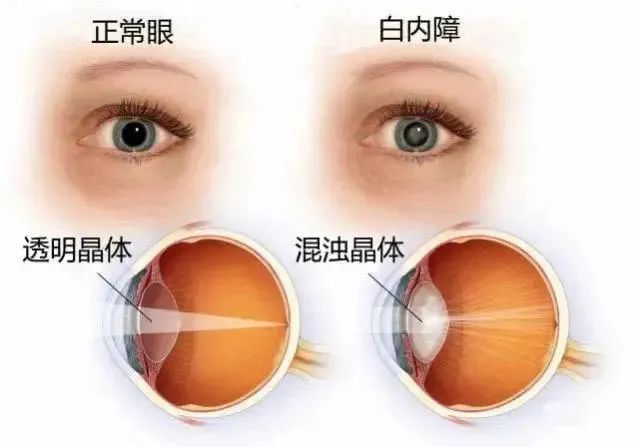 水蛭素、白內(nèi)障、復方水蛭滴眼液