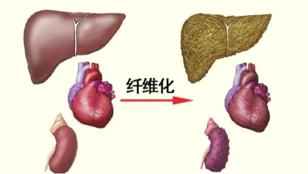 水蛭是臨床常用的活血藥物，能有效治療器官纖維化