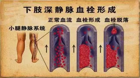 水蛭素、水蛭素膠囊、壯醫(yī)水蛭療法