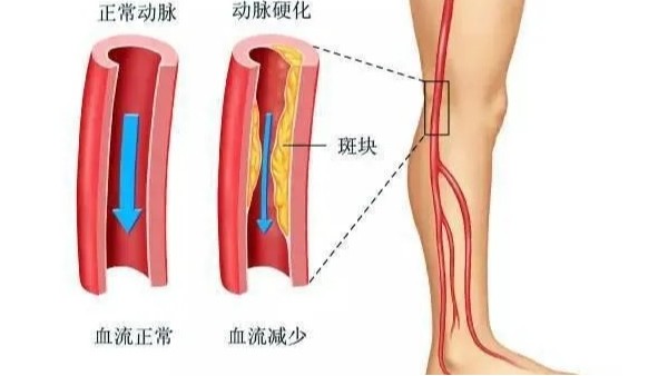 水蛭在改善下肢動脈硬化性閉塞癥中發(fā)揮重要療效，安全性及可行性較高