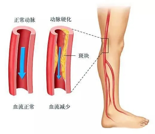 水蛭素、下肢動(dòng)脈硬化、下肢閉塞