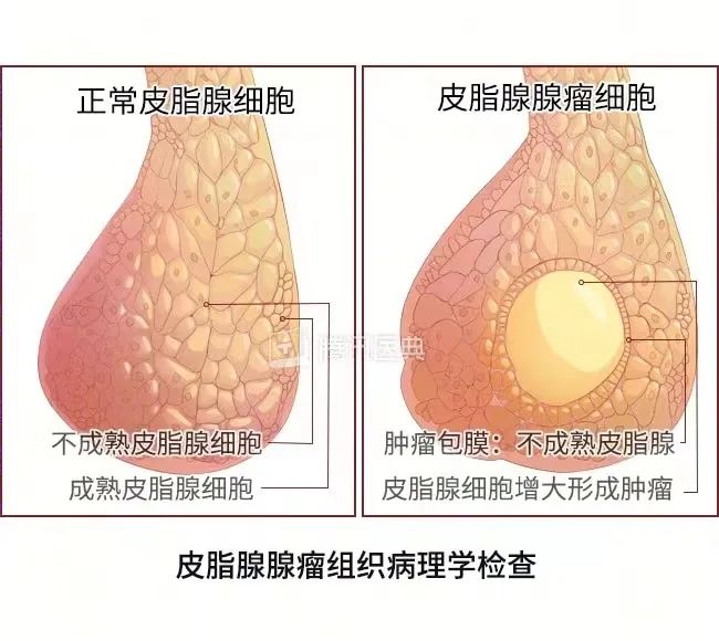 壯醫(yī)水蛭療法，天然水蛭素膠囊