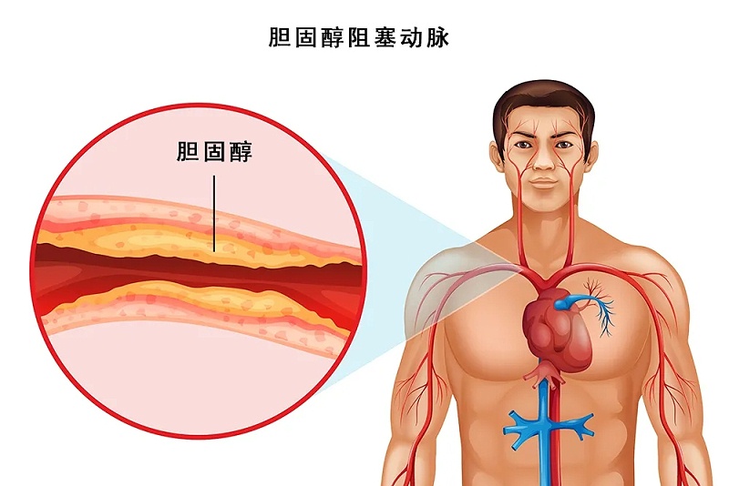 水蛭素、脖子粗、血管硬化