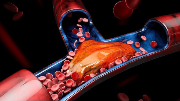 血栓最容易堵在身體3個(gè)地方！有這4個(gè)信號(hào)一定要留意→