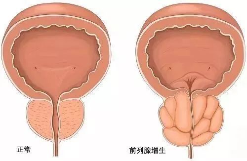 水蛭素、前列腺增生、前列腺肥大