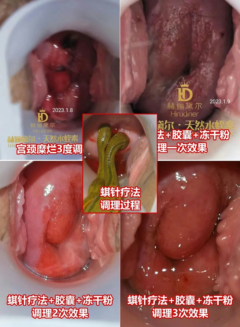 水蛭素、水蛭素膠囊、生殖婦科