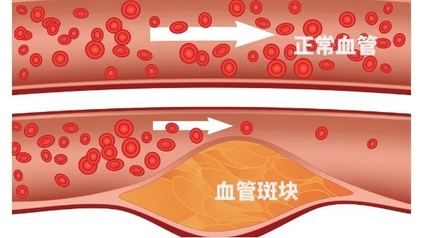 微血栓堵塞可能會致命