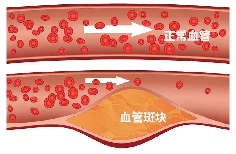 水蛭素、通血管、血管堵塞