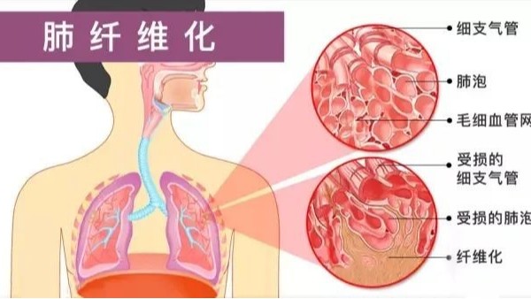 研究稱水蛭素可通過調(diào)控p38 MAPK/NF-κB信號(hào)通路抗肺纖維化