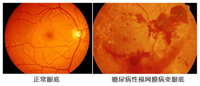 水蛭素、糖尿病、視網(wǎng)膜病變