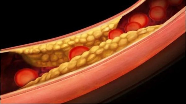 三高如何引起動脈粥樣硬化斑塊？——高血壓篇