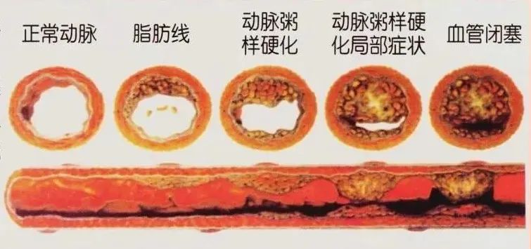 水蛭素、動(dòng)脈粥樣硬化、高血壓