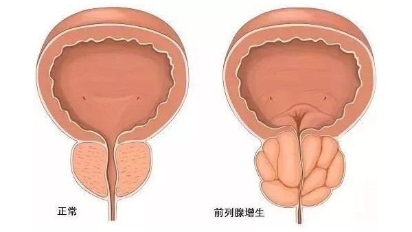 水蛭在改善前列腺增生臨床癥狀、提高生活質(zhì)量方面發(fā)揮重要作用