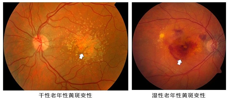 壯醫(yī)水蛭療法,天然水蛭素