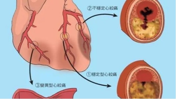 尿酸高不僅導(dǎo)致痛風(fēng)，還可能威脅你的心臟和大腦！