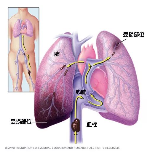 水蛭素、猝死、心梗