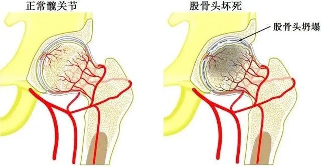 水蛭素-股骨頭壞死-水蛭通脈湯